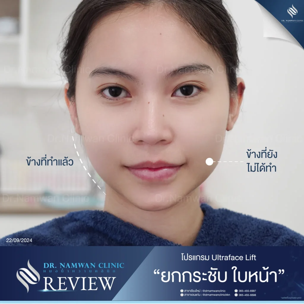 ยกกระชับ เชียงใหม่