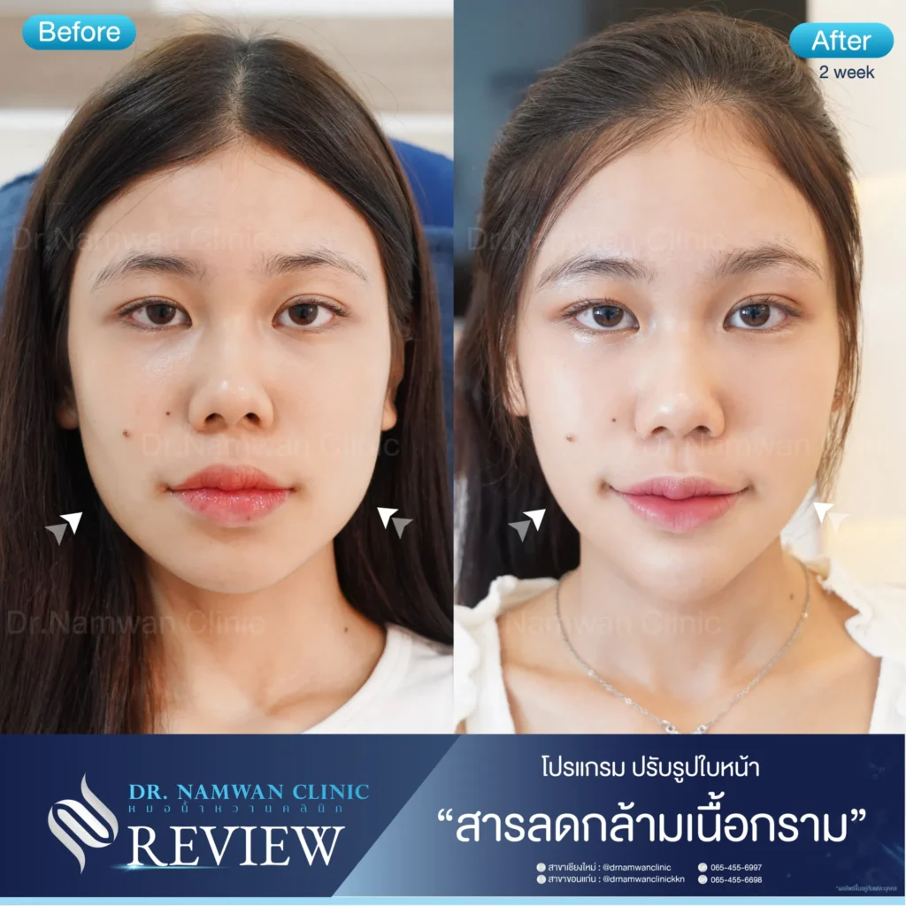 ลดริ้วรอย เชียงใหม่