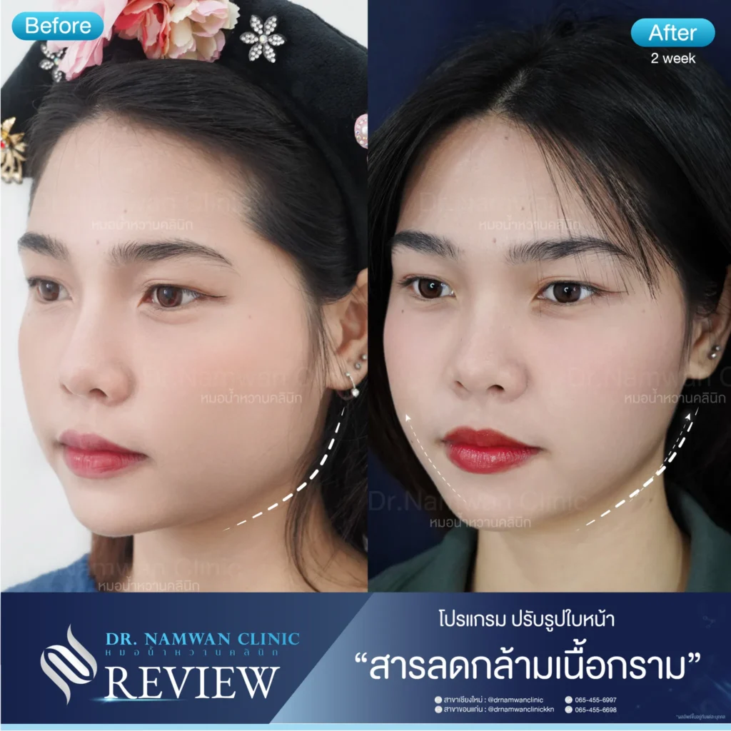 ลดริ้วรอย เชียงใหม่