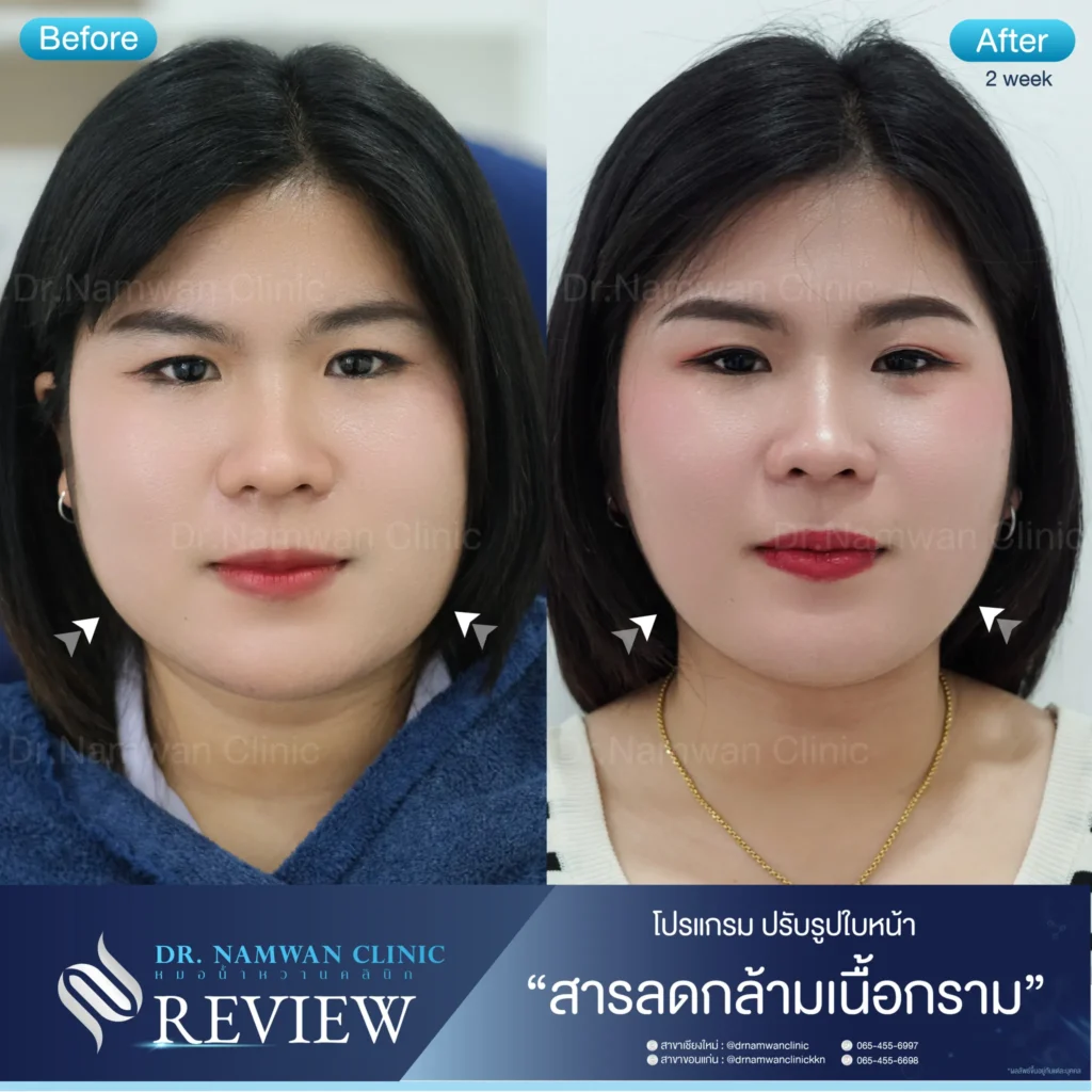 ลดริ้วรอย เชียงใหม่