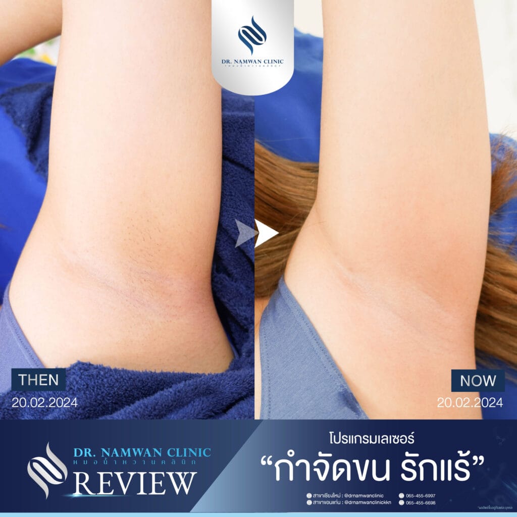 B-A diode ขนรักแร้-02