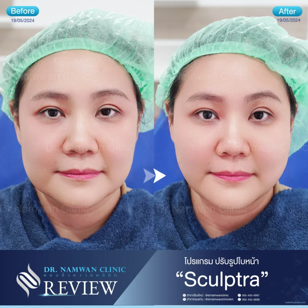Sculptra เชียงใหม่
