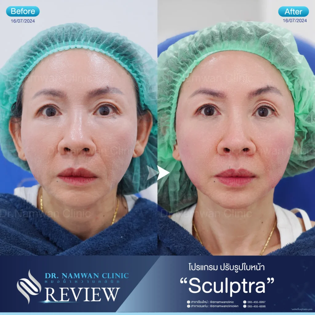 Sculptra เชียงใหม่