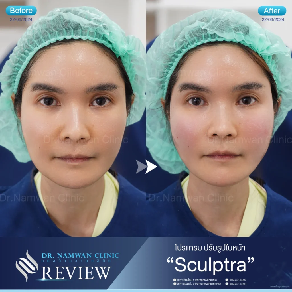 Sculptra เชียงใหม่