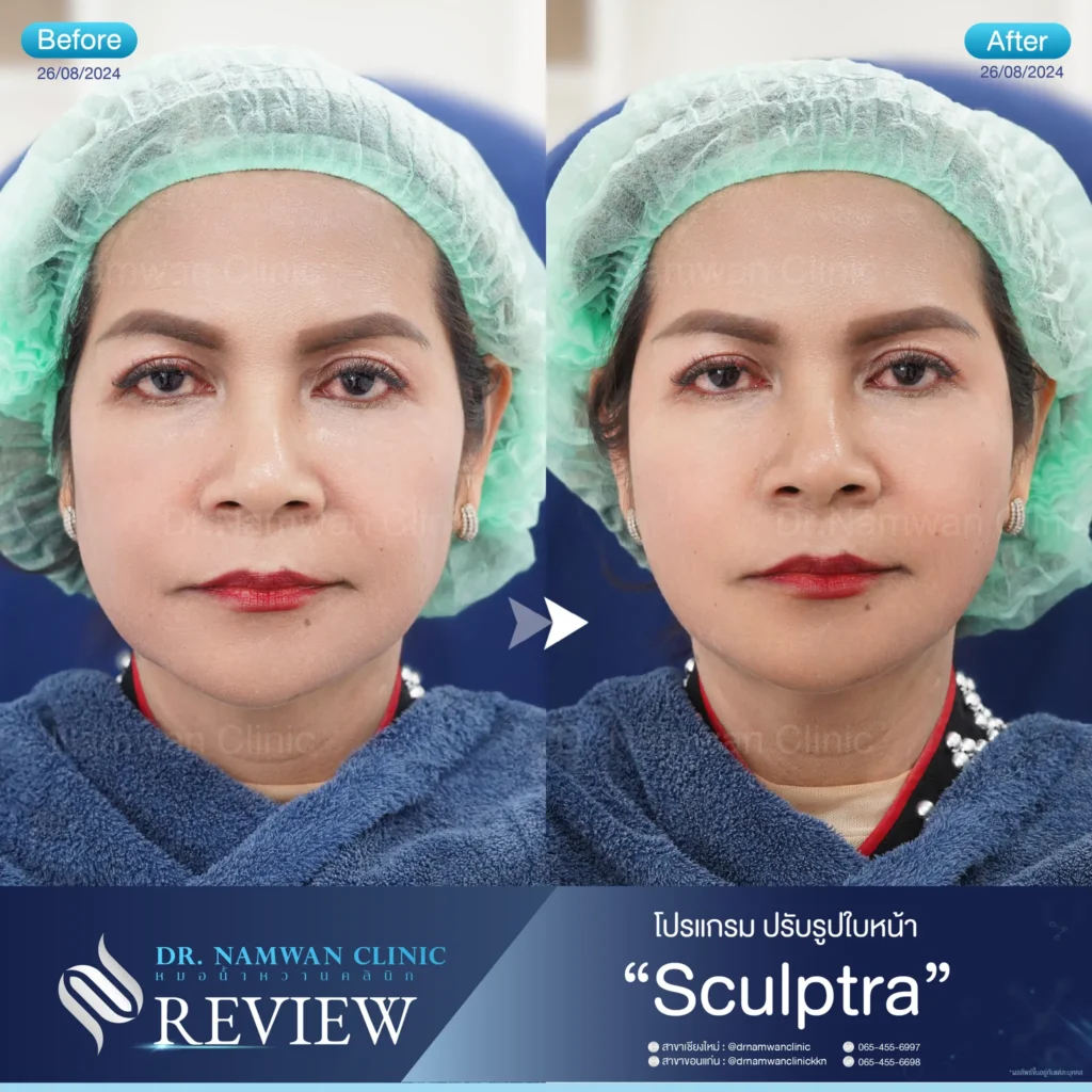 Sculptra เชียงใหม่