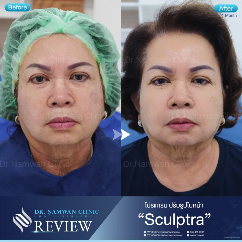 Sculptra เชียงใหม่
