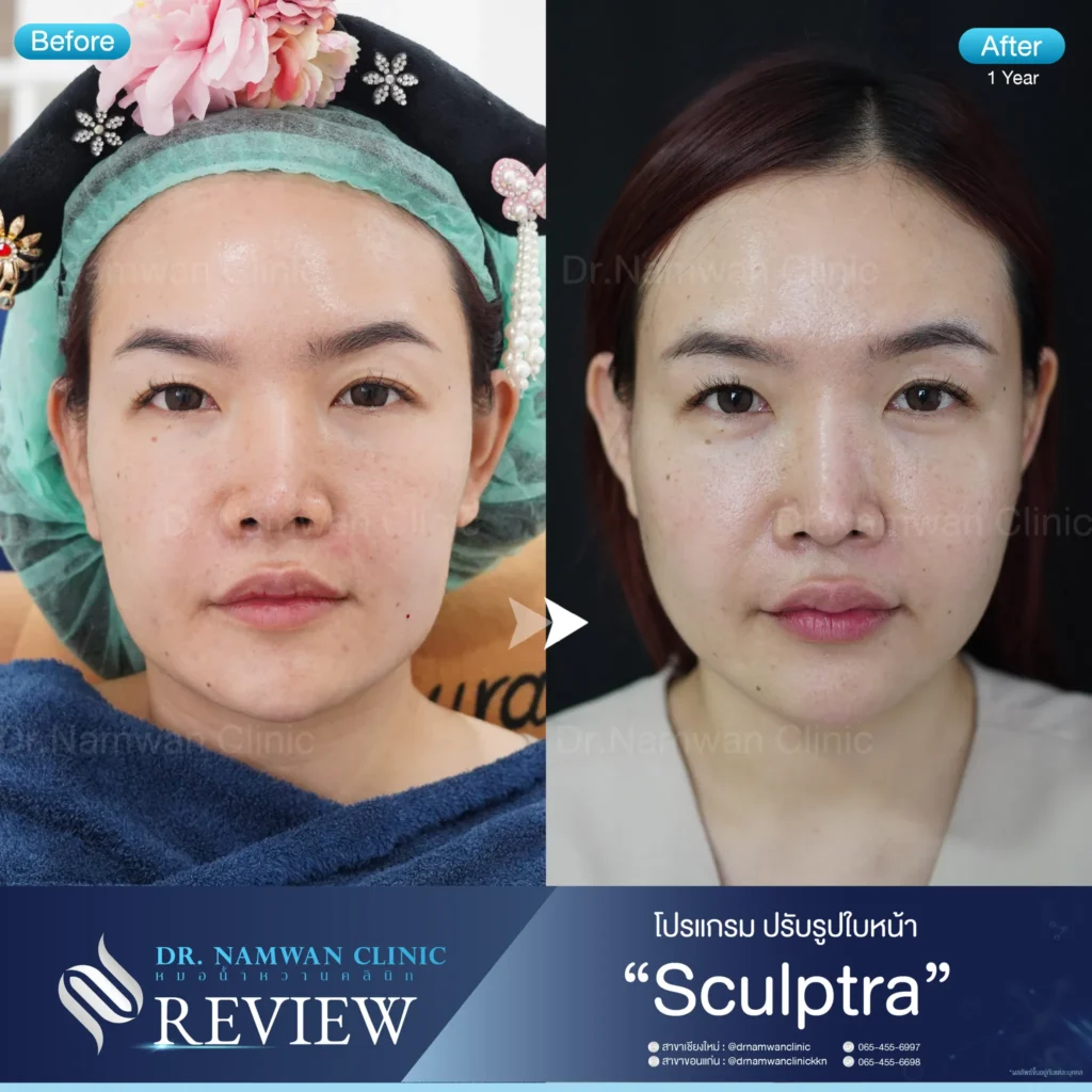 Sculptra เชียงใหม่