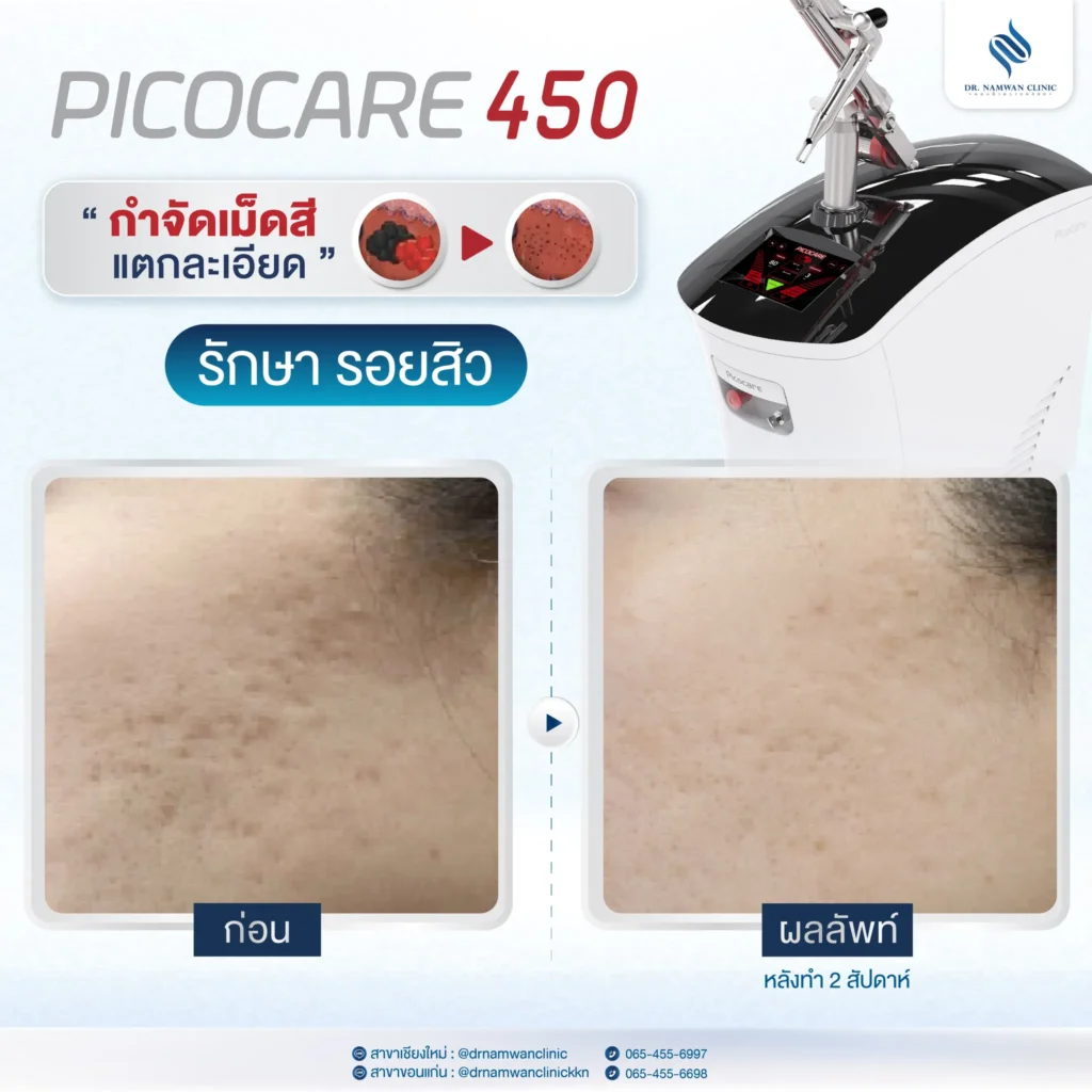 Pico Laser เชียงใหม่