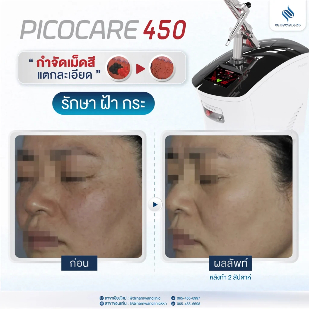 Pico Laser เชียงใหม่