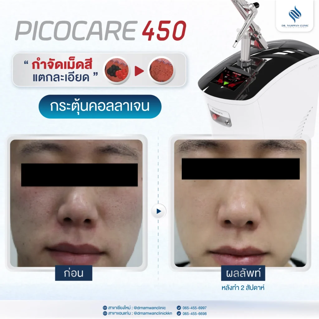 Pico Laser เชียงใหม่