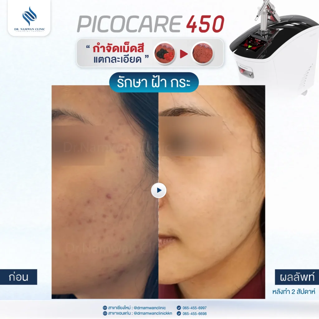 Pico Laser เชียงใหม่