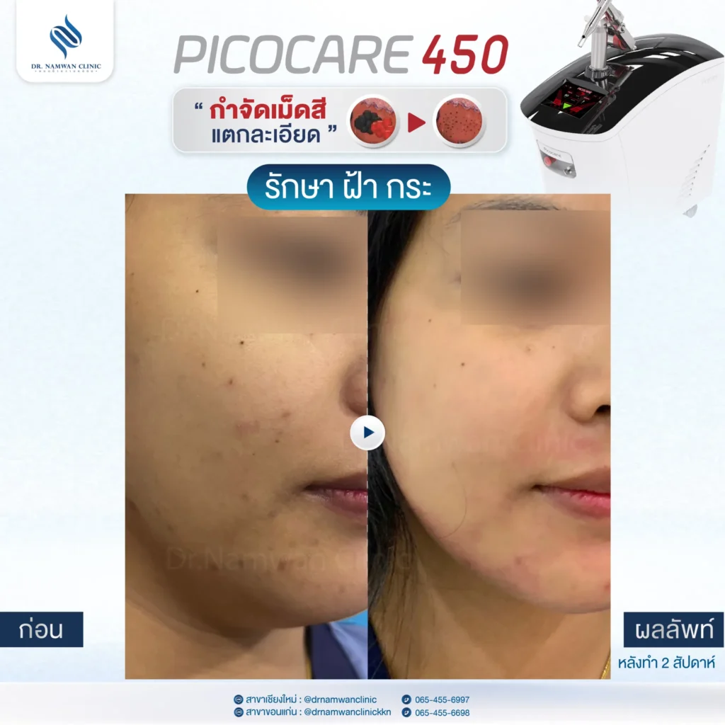 Pico Laser เชียงใหม่