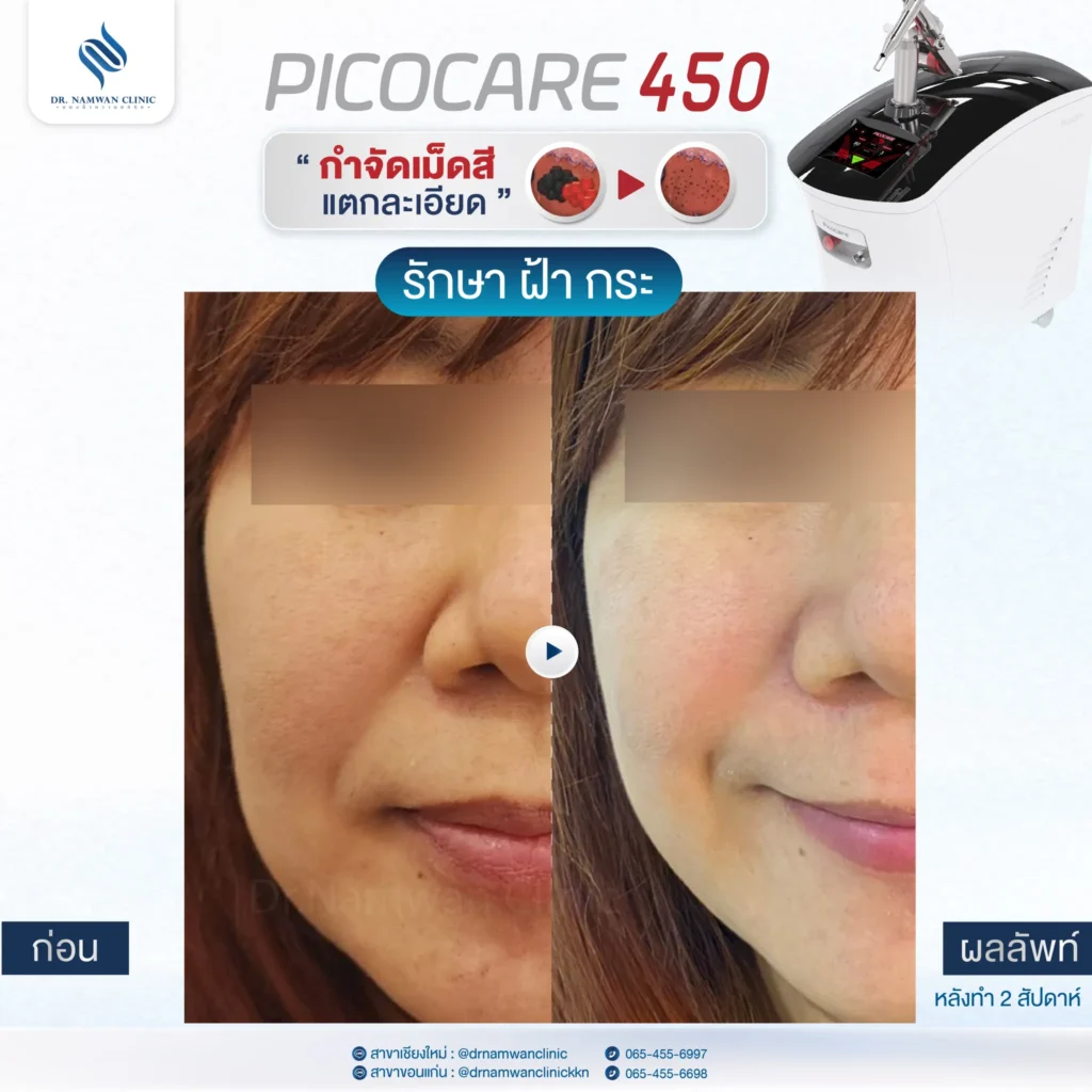 Pico Laser เชียงใหม่