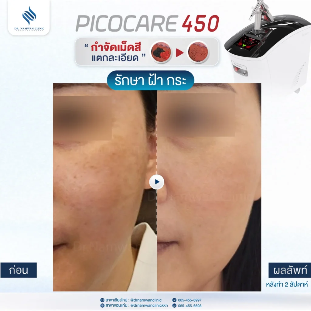 Pico Laser เชียงใหม่