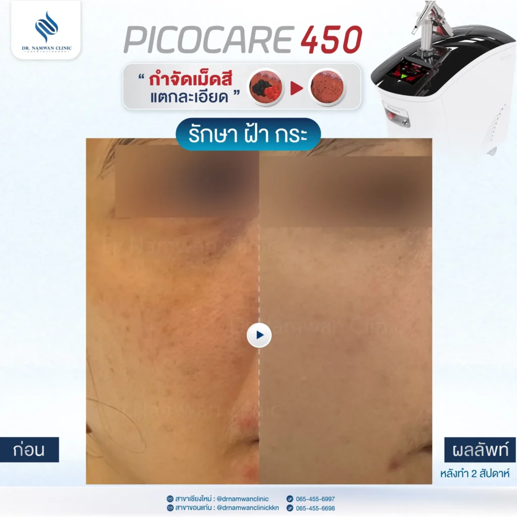 Pico Laser เชียงใหม่