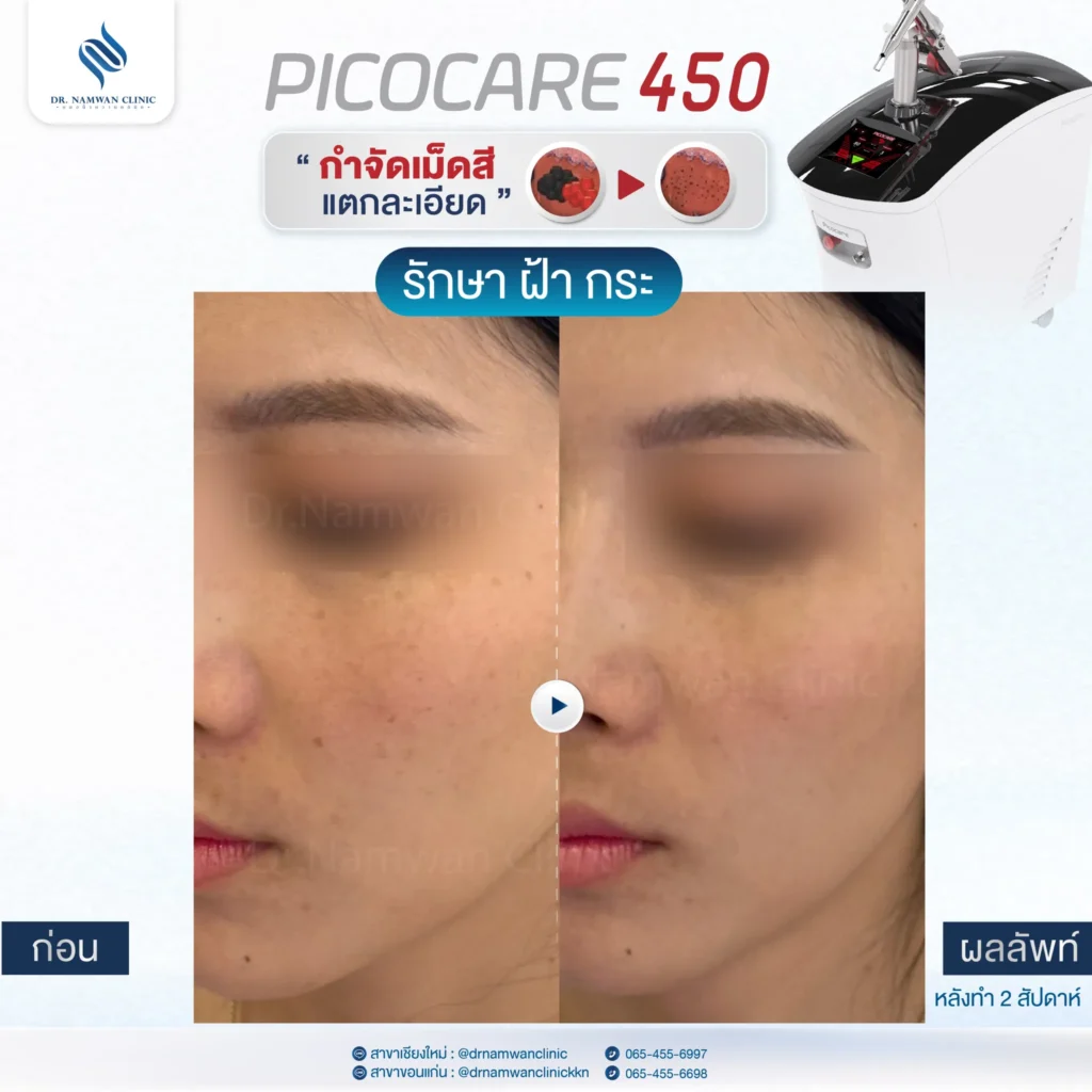 Pico Laser เชียงใหม่