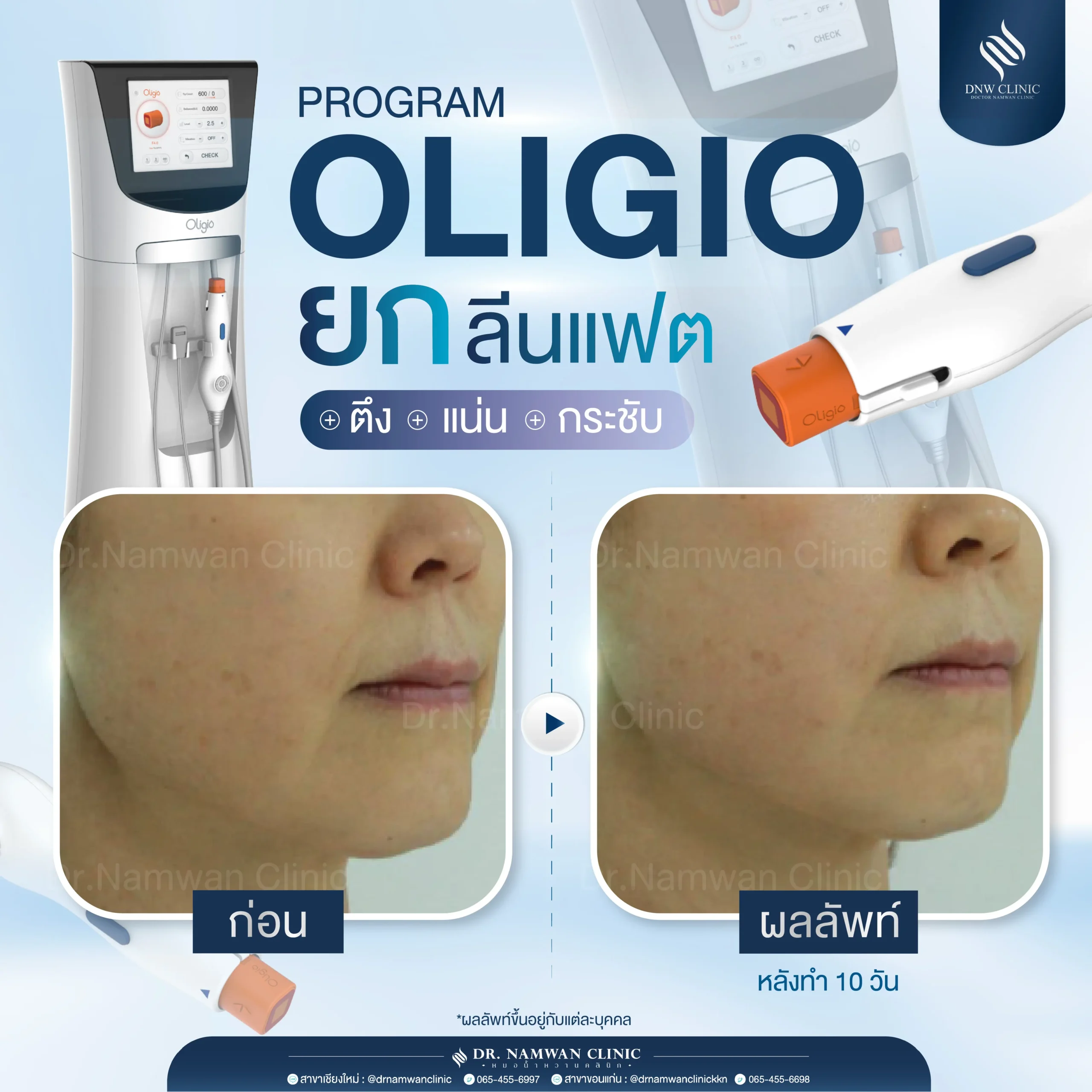 รีวิว Oligio-01