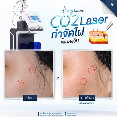 CO2 Laser_Review_1