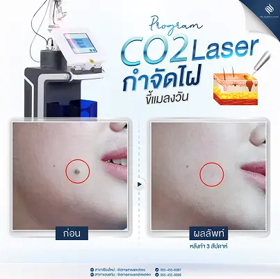 CO2 Laser_Review_2