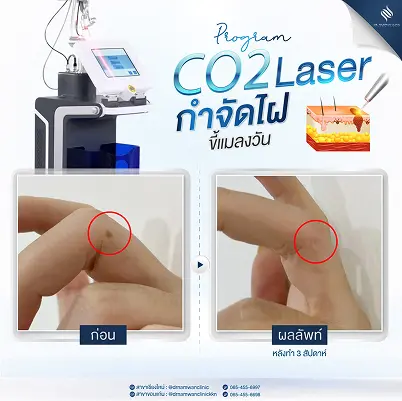 CO2 Laser_Review_3